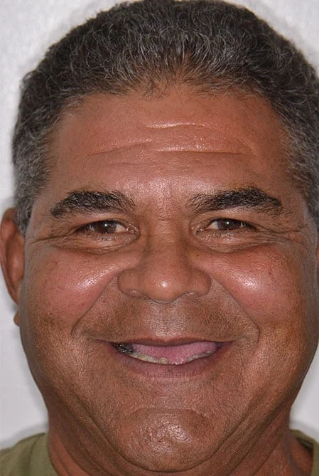 before-after-vertical-001-b