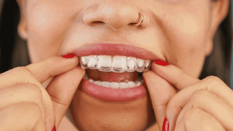 How Long Do Invisalign Refinements Take
