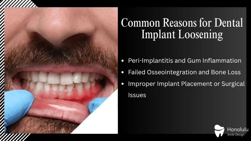 Major Causes of a Loose Tooth Implant