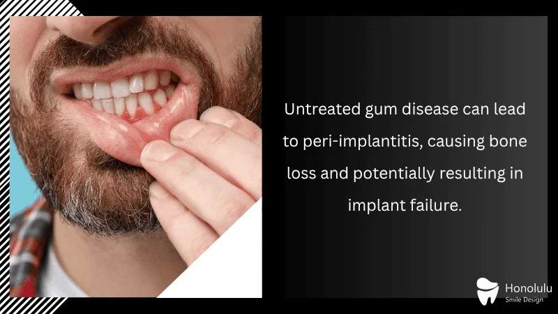 Risks of Implant Failure with Untreated Gum Disease