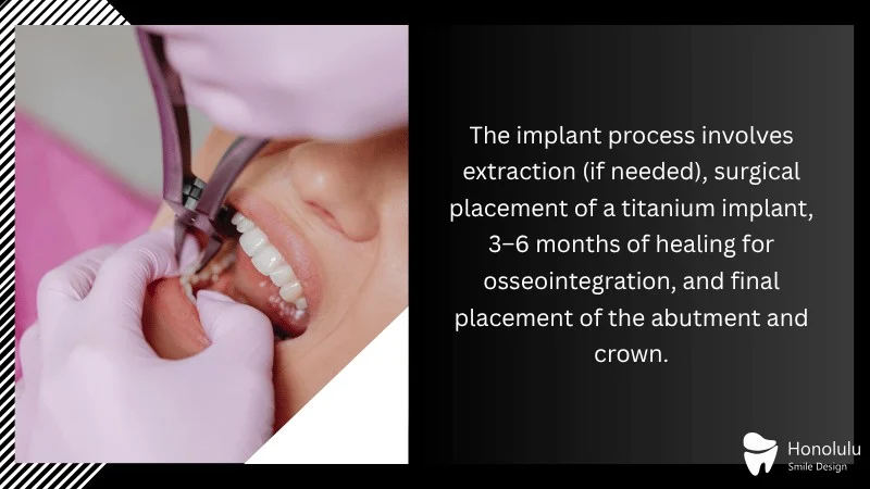 The Dental Implant Procedure and Timeline