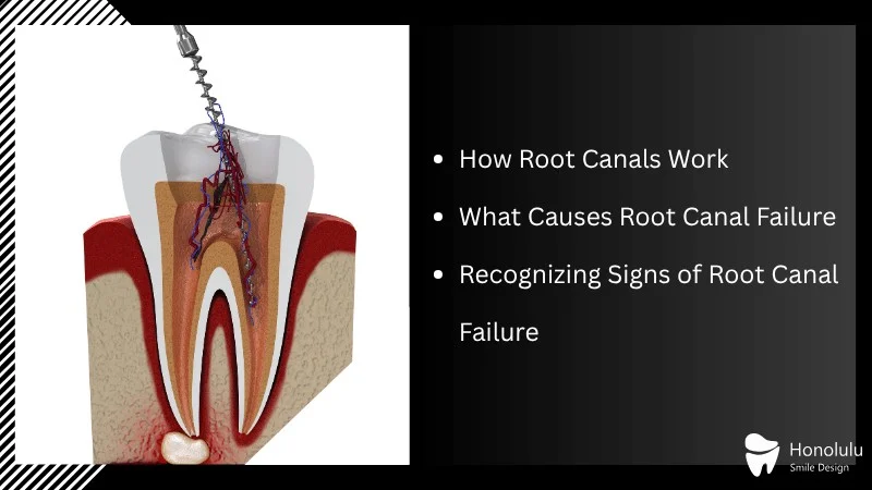 Understanding Root Canal Treatment and Its Limits