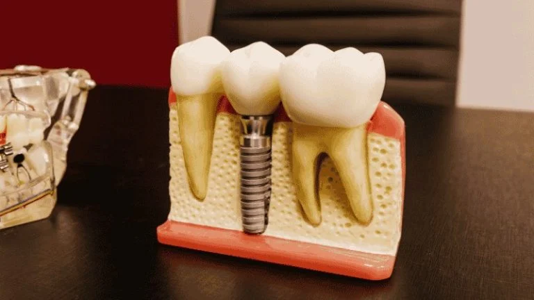how long do dental implants last
