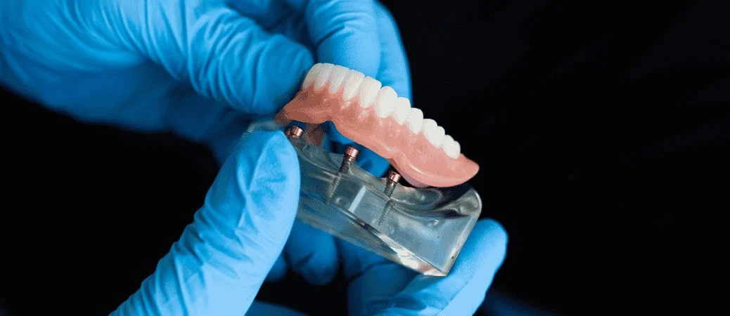 All on 4 vs implant supported dentures